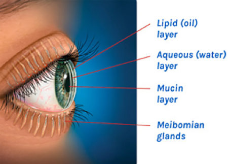 Types Of Dry Eye Disease Eyedry Blepharitis Rosacea Center